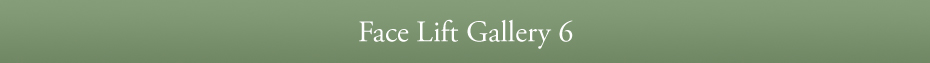 Face Lift Gallery 6