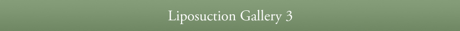 Liposuction Gallery 3